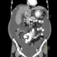 Liver cirrhosis, macronodular, ascites, massive: CT - Computed tomography